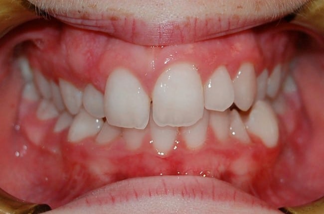 mordida cruzada ortodoncia clinica dental en Pinto mordida cruzada ortodoncia clinica dental en pinto