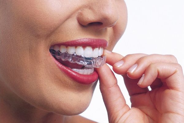 Ortodoncia Invisible clinica dental pinto Ortodoncia Invisible clinica dental pinto
