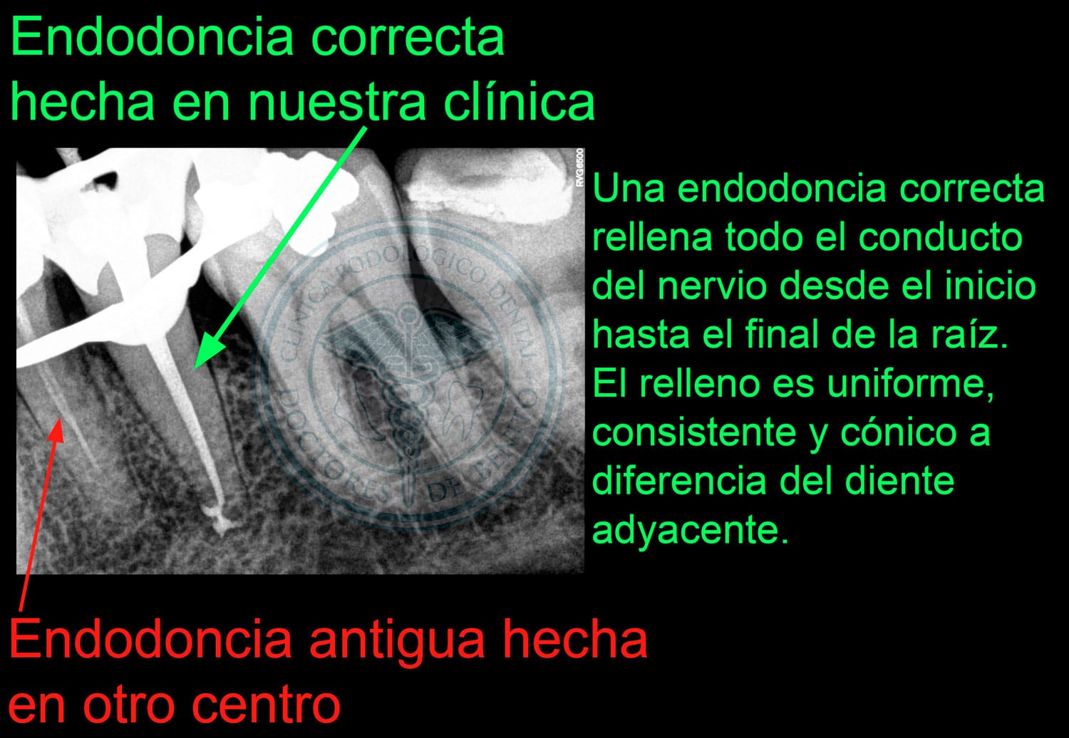 Endodoncia incorrecta vs correcta