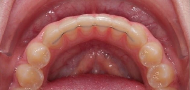 retención ortodoncia