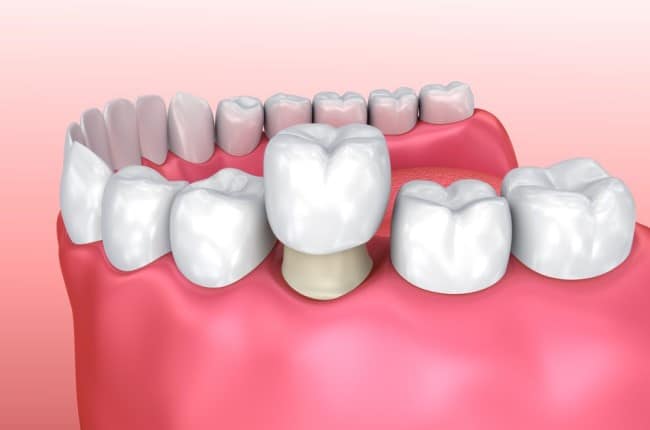 BOCCA Clinicas Dentales - Corona Metal-Porcelana sobre núcleo metálico. Si  se respetan las indicaciones, si se trabaja con materiales de excelente  calidad y si se hace una buena odontología el resultado es