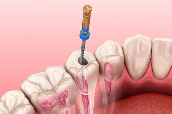 Endondoncia tratamiento dental